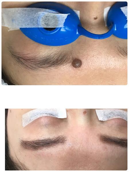 A very subtle scar on the glabellar area near left eyebrow