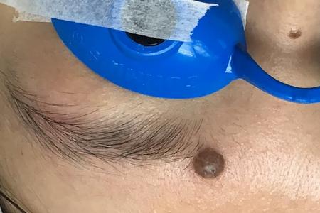A dark brown mole on glabellar area near left eyebrow