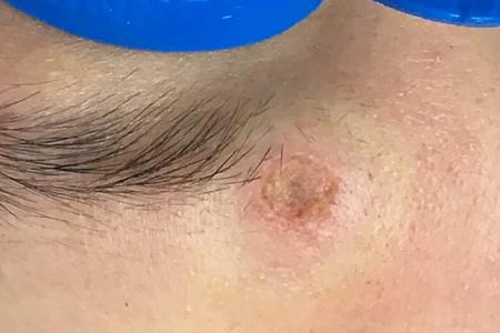 A skin colour wound (depressed) in the glabellar area near left eyebrow