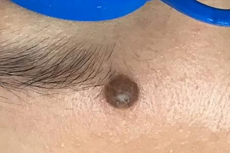 A dark brown mole on glabellar area near left eyebrow