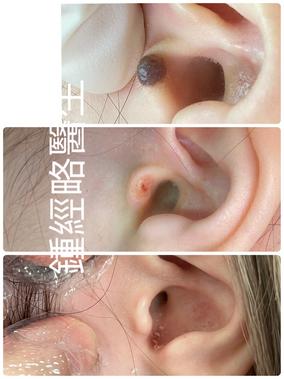 3 stages of laser removal of a mole on tragus