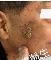 激光脫疣前後對比圖。術前，一粒大疣生長在右邊面部。術後，疤痕幾乎看不見。