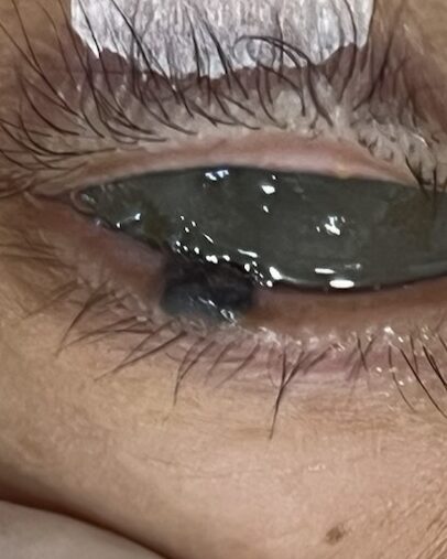 一粒位於下眼皮眼瞼邊緣位置的凸出來的啡色痣