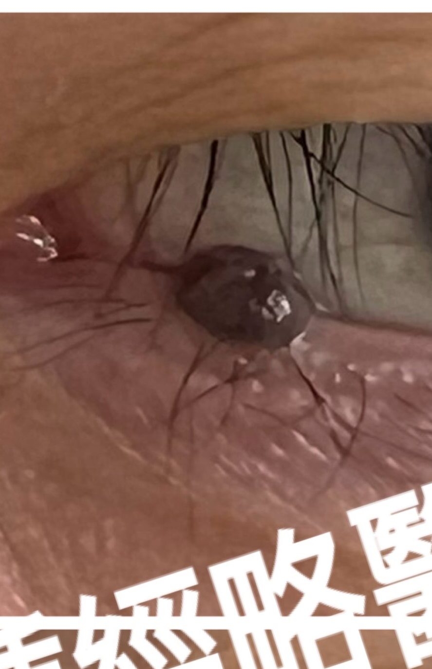 激光脫除下眼瞼／眼線位置的墨痣的前後對比圖
