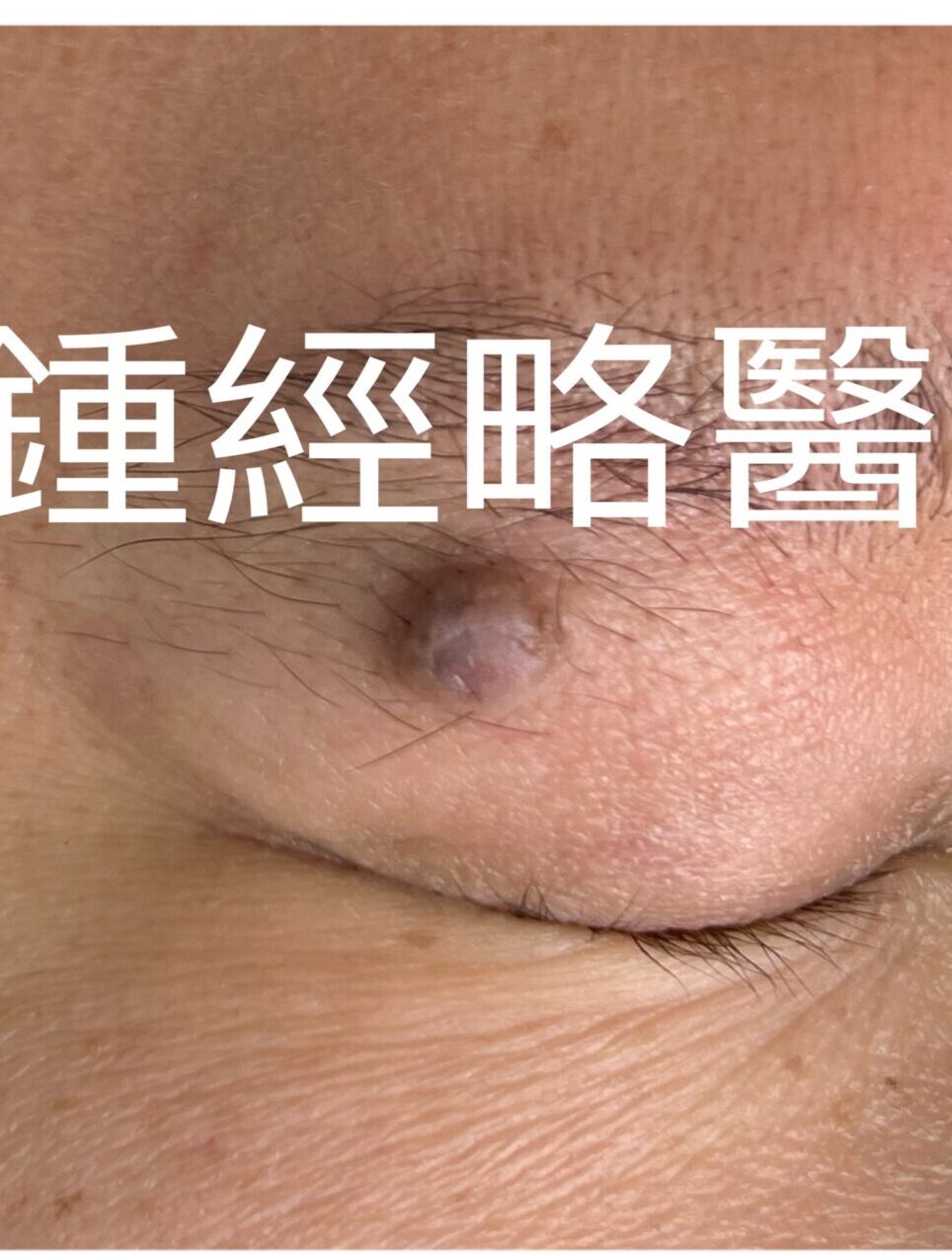 激光脫眼眉毛墨痣的手術前後照片-幾乎看不見疤痕