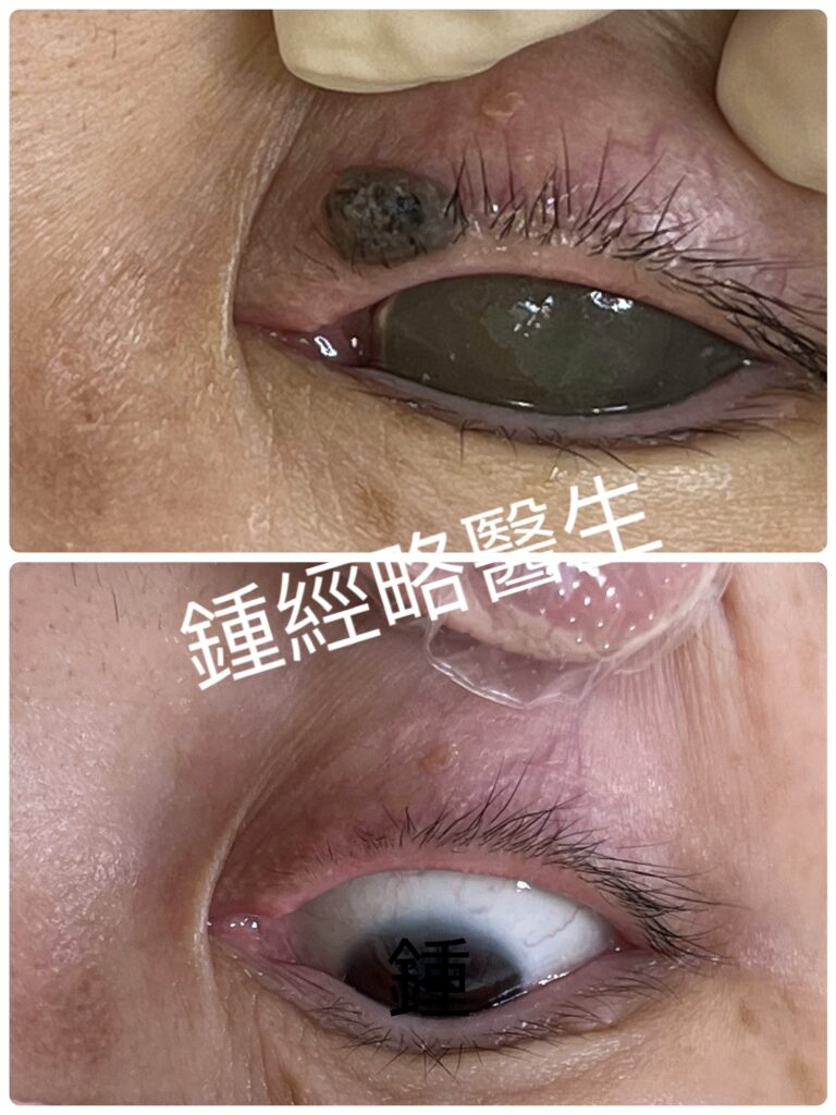 激光脫瞼緣痣（眼線墨）之後幾乎看不見疤痕