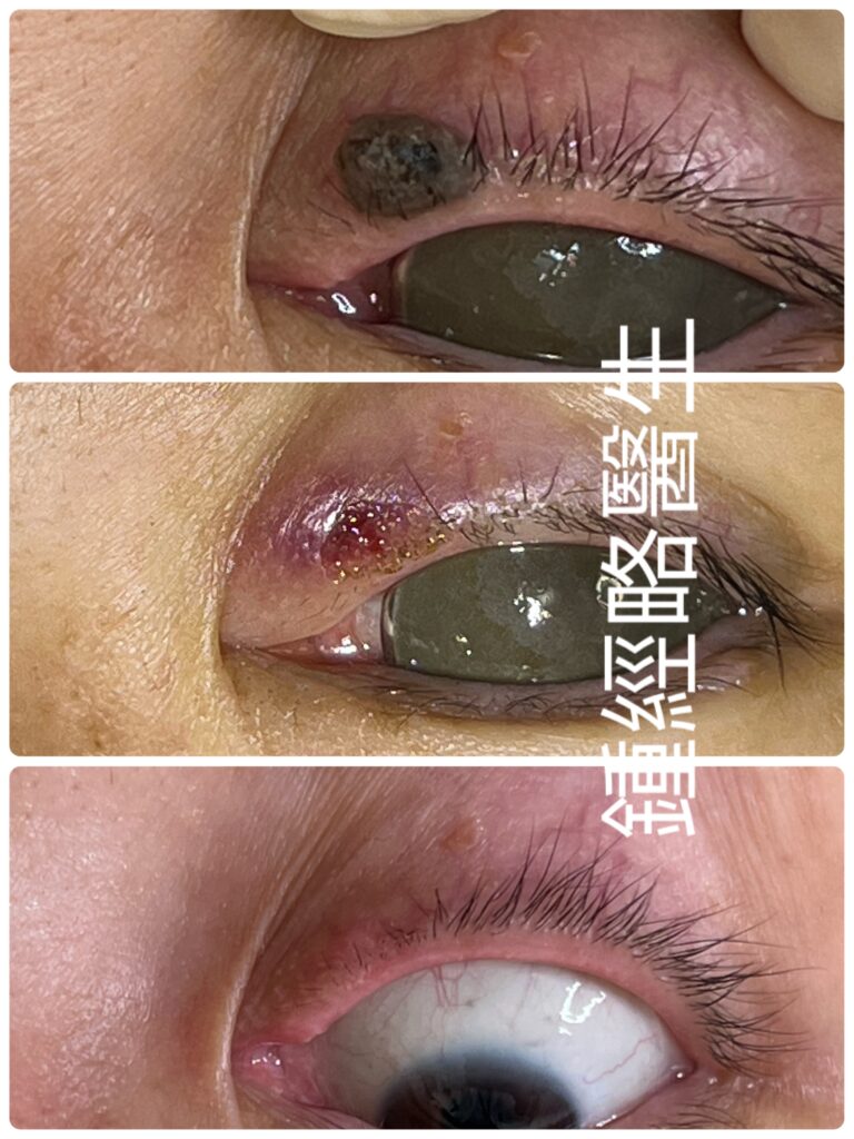 上眼瞼緣激光脱痣／墨後的傷口－沒有流血，墨／痣根部完全清除，毛囊根部完全保留，毛髮得以完全長出，疤痕幾乎不見
