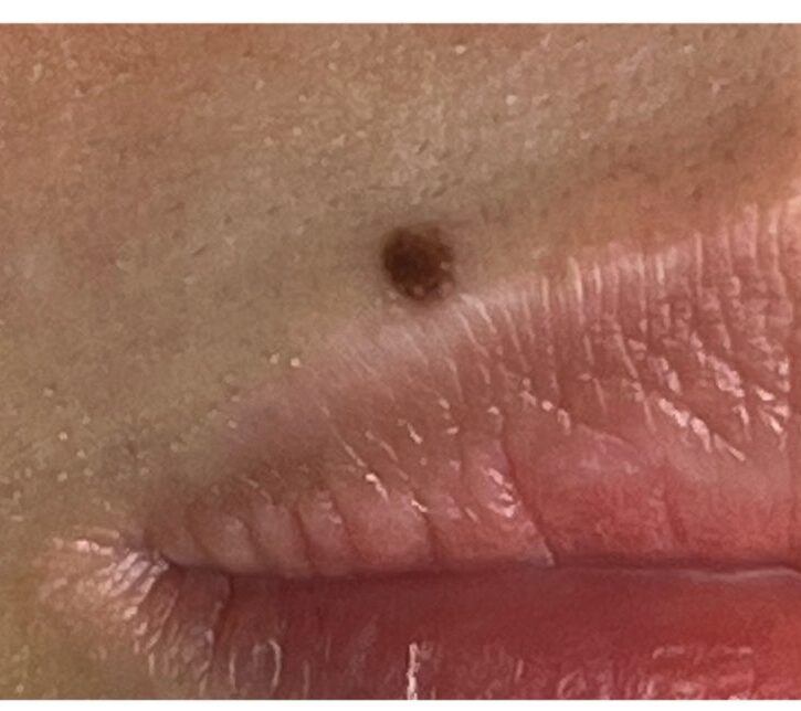 激光脫除一粒位於唇線邊緣的一粒墨痣的連環圖